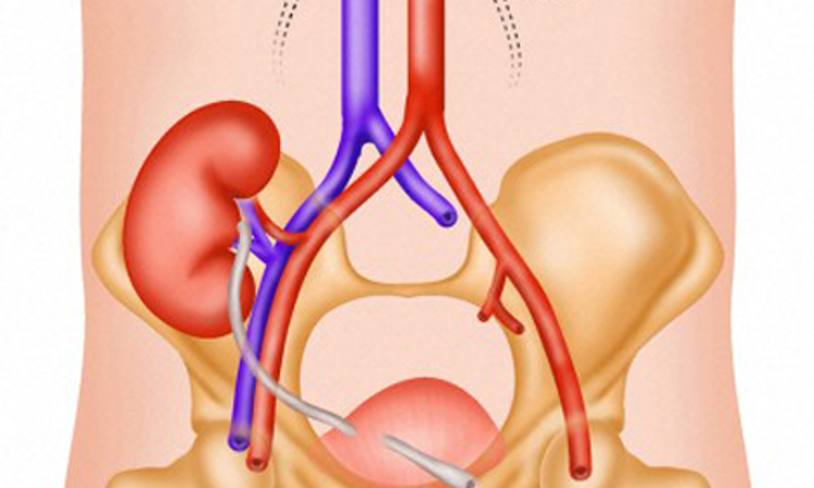 Kidney Transplant