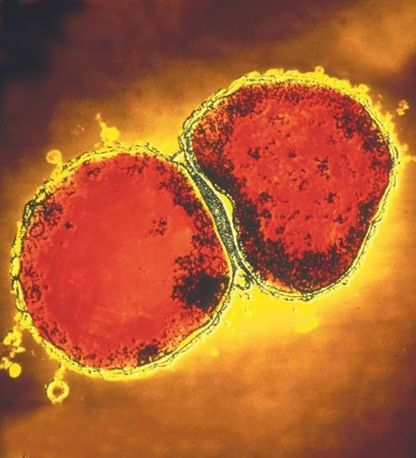 Laser Fingerprinting of Meningitis